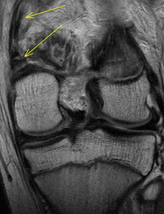 Figure 2 for case Avulsion fracture of the adductor magnus insertion